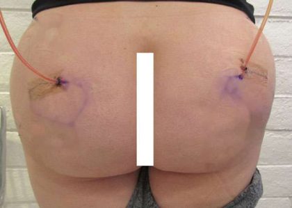 Fat Necrosis and Dead Fat Removal Before & After Patient #8586