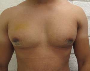 Gynecomastia Before & After Patient #8602