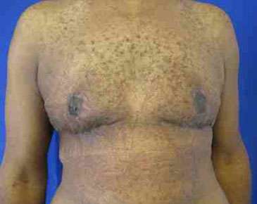 Gynecomastia Before & After Patient #8612