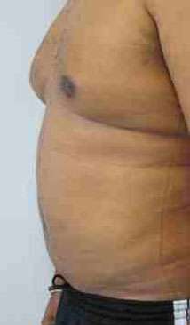 Gynecomastia Before & After Patient #8616