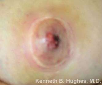 Inverted Nipple Correction Before & After Patient #8628