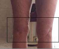 Knees Before & After Patient #8637