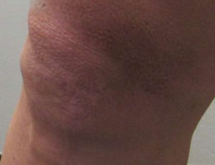 Knees Before & After Patient #8642