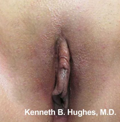 Labial Rejuvenation Before & After Patient #8663