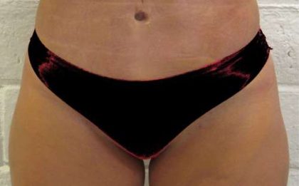 Bodytite Before & After Patient #6155