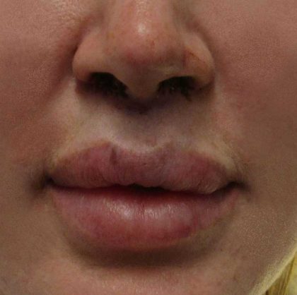 Lip Lift Before & After Patient #8675