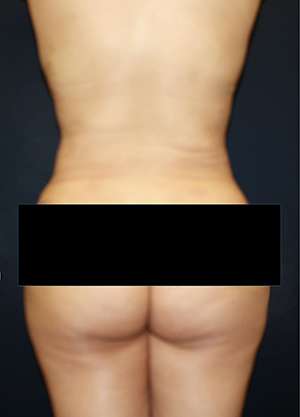 Liposuction Before & After Patient #8727