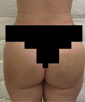 Liposuction Before & After Patient #8736