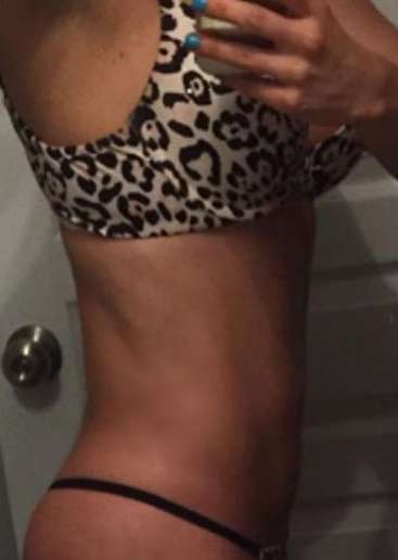 Liposuction Before & After Patient #8750