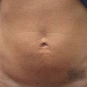 Abdomen Before & After Patient #5869