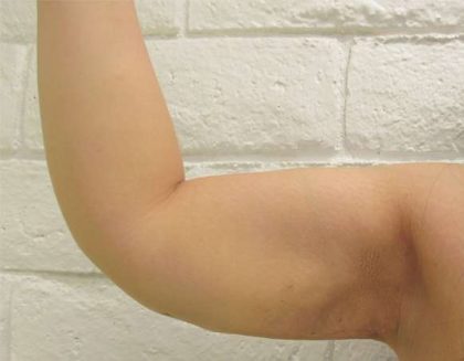 Bodytite Before & After Patient #6167