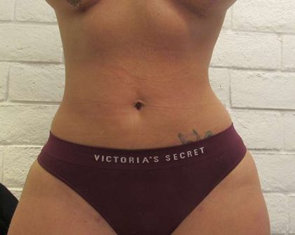 Liposuction Before & After Patient #8774