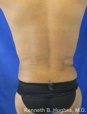 Liposuction Before & After Patient #8794