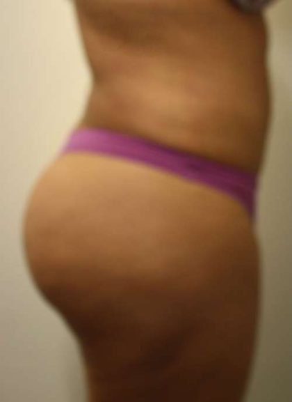 Liposuction Before & After Patient #8797