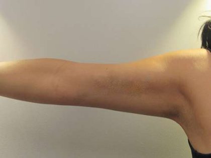 Bodytite Before & After Patient #6170