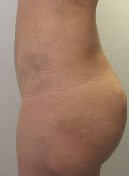 Liposuction Before & After Patient #8802