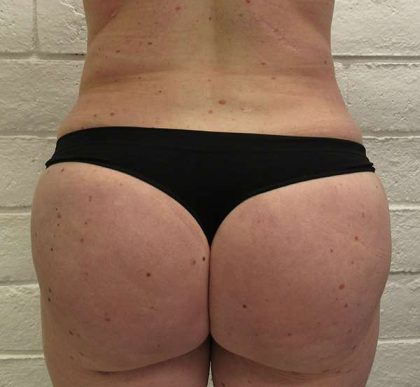 Liposuction Before & After Patient #8829