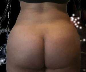 Liposuction Before & After Patient #8837