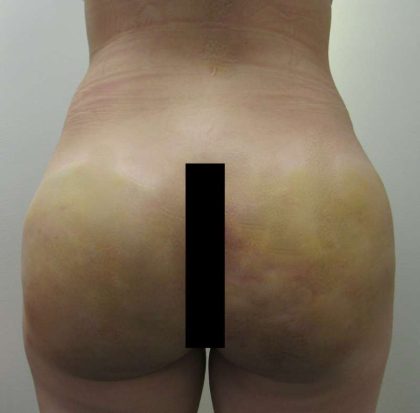 Liposuction Before & After Patient #8844