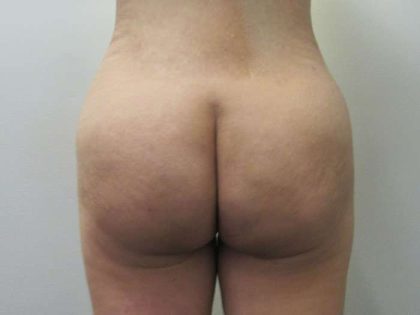 Liposuction Before & After Patient #8852