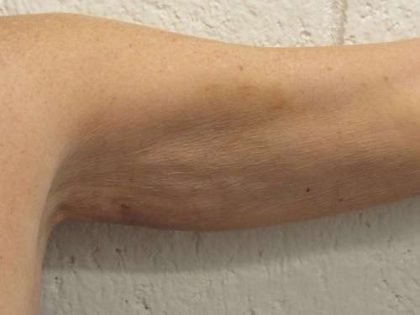 Bodytite Before & After Patient #6178