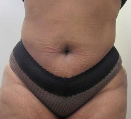 Liposuction Before & After Patient #8896