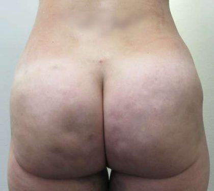Liposuction Before & After Patient #8903