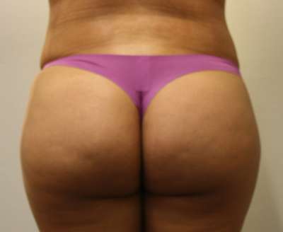 Liposuction Before & After Patient #8935