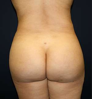 Liposuction Before & After Patient #8943