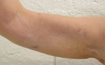 Bodytite Before & After Patient #6181