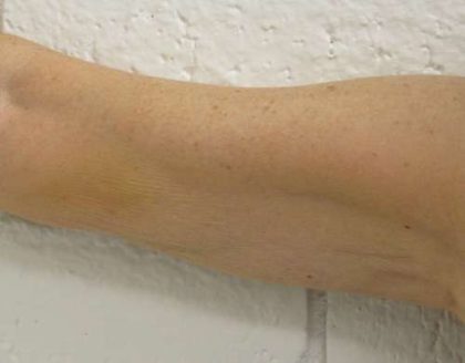 Bodytite Before & After Patient #6184