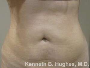 Liposuction Before & After Patient #9012