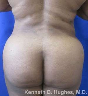 Liposuction Before & After Patient #9017