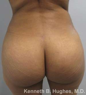 Liposuction Before & After Patient #9040