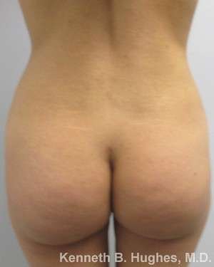 Liposuction Before & After Patient #9043