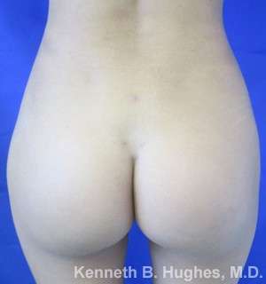 Liposuction Before & After Patient #9046