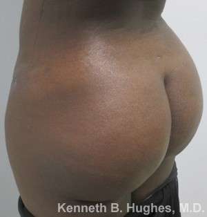 Liposuction Before & After Patient #9057