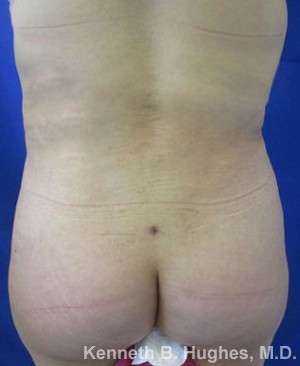Liposuction Before & After Patient #9063