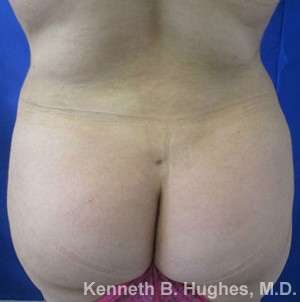 Liposuction Before & After Patient #9087