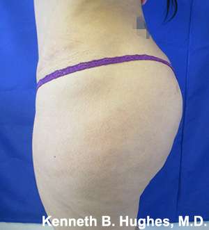 Liposuction Before & After Patient #9107