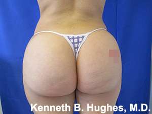Liposuction Before & After Patient #9120