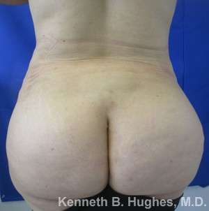 Liposuction Before & After Patient #9128