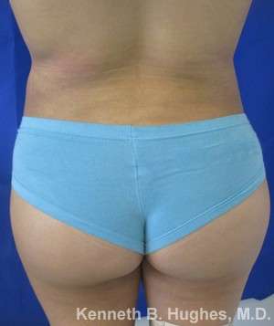 Liposuction Before & After Patient #9136