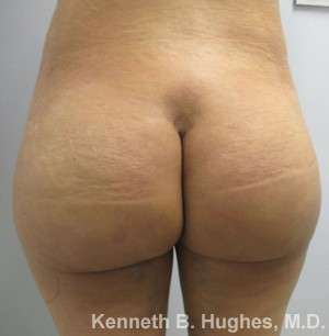 Liposuction Before & After Patient #9141
