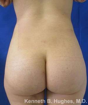 Liposuction Before & After Patient #9149