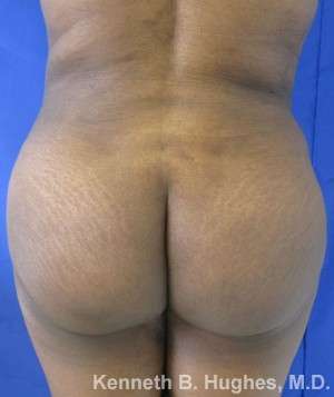 Liposuction Before & After Patient #9152