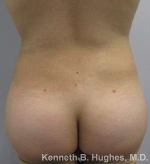 Liposuction Before & After Patient #9160