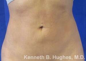 Liposuction Before & After Patient #9167