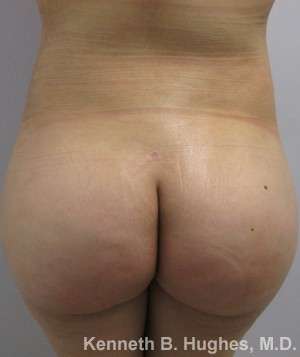Liposuction Before & After Patient #9172