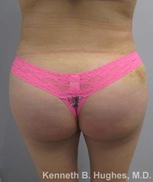 Liposuction Before & After Patient #9175